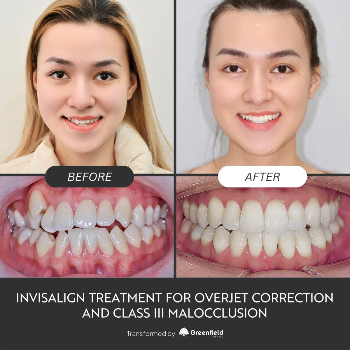 Case 18794 - results for overjet and class III malocclusion