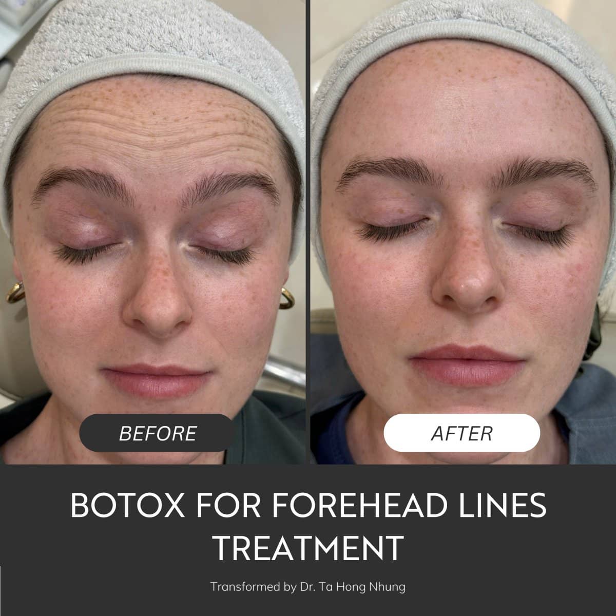 Case 18796 - Botox for forehead lines