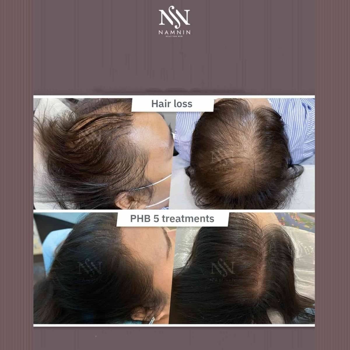 Case 18802 - hair mesotherapy