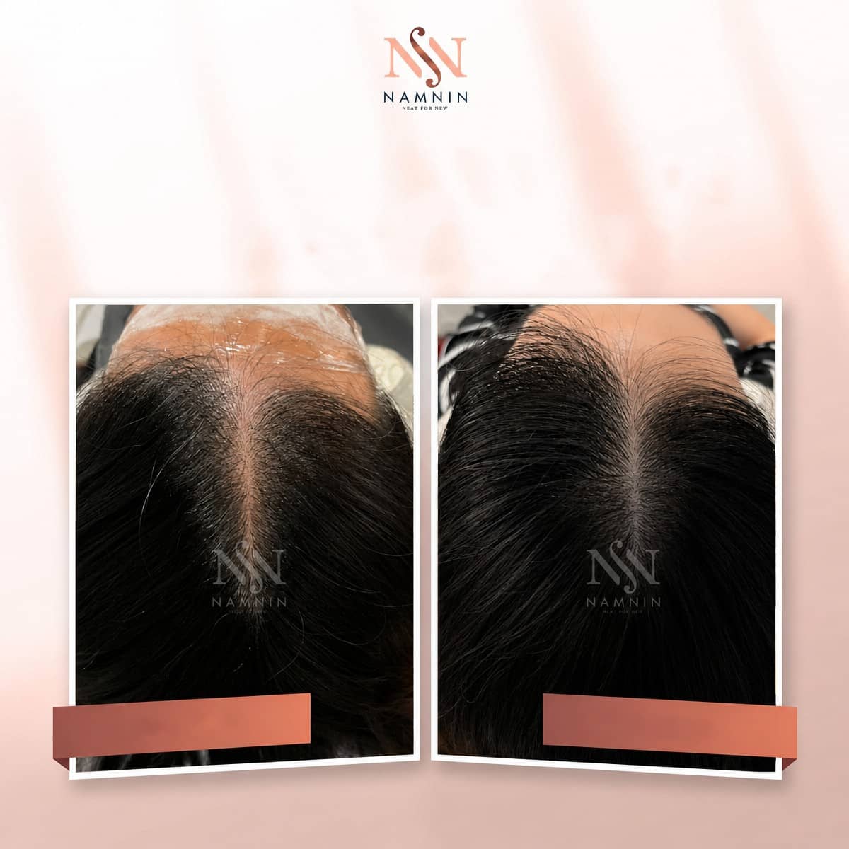 Case 18809 - hair mesotherapy