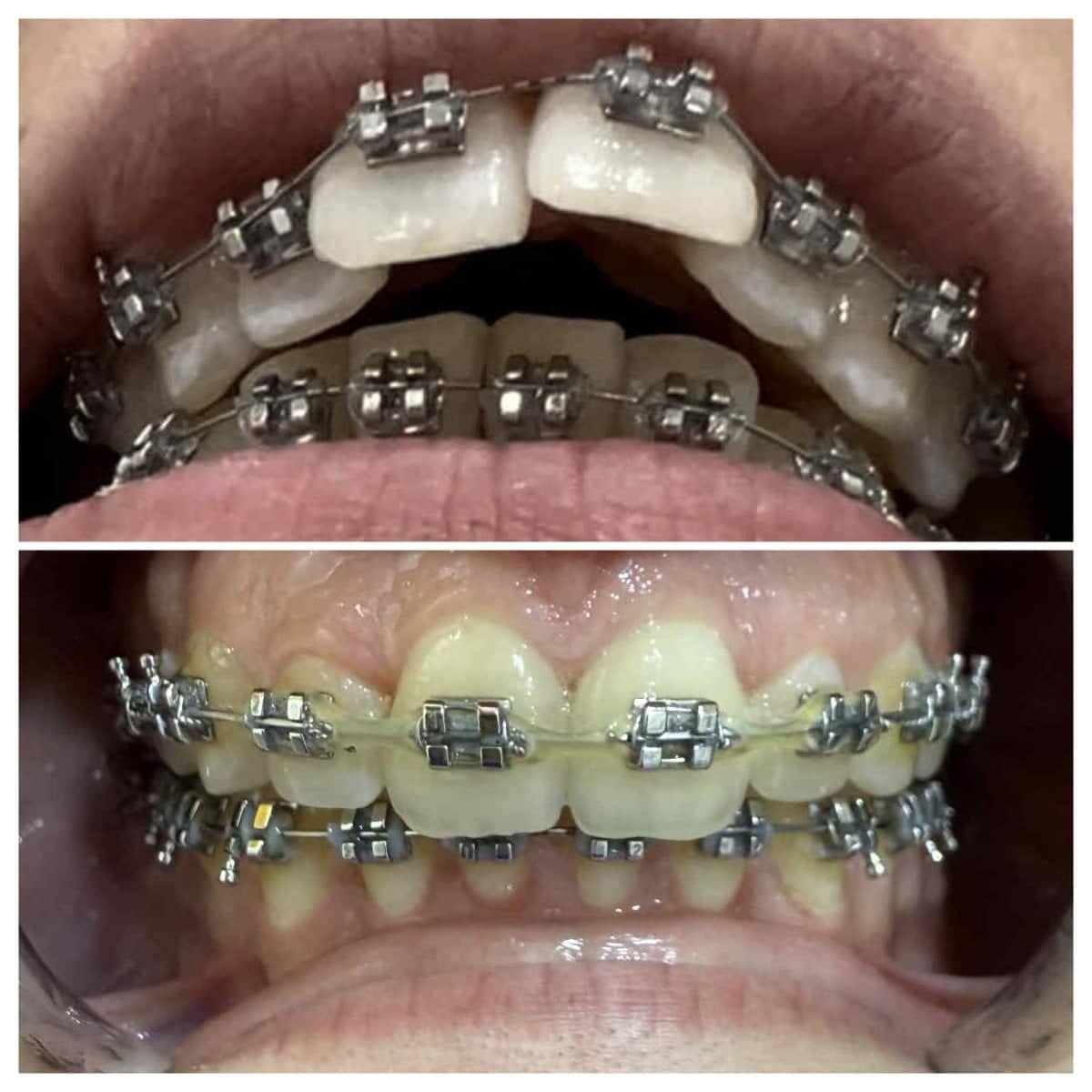 Case 18838 - braces treatment