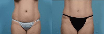Case 1887 - Woman treated with Tummy Tuck