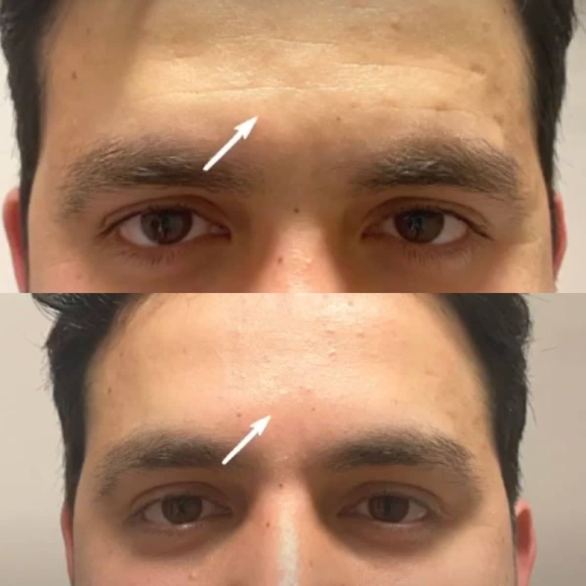 Case 18877 - fillers injection