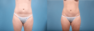 Case 1888 - Woman treated with Tummy Tuck