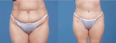 Case 1889 - Woman treated with Tummy Tuck