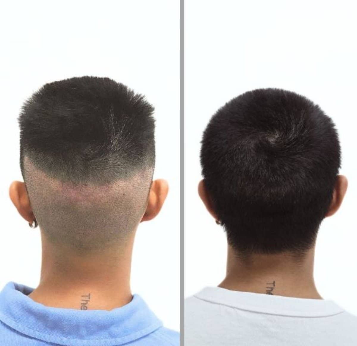 Case 18899 - hair transplant
