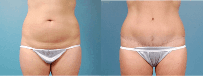 Case 1890 - Woman treated with Tummy Tuck