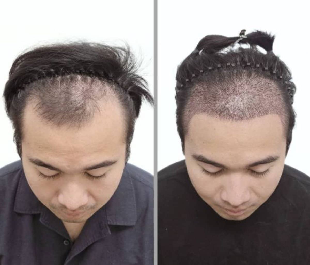 Case 18900 - hair transplant