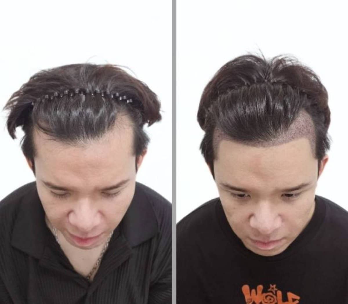Case 18901 - hair transplant