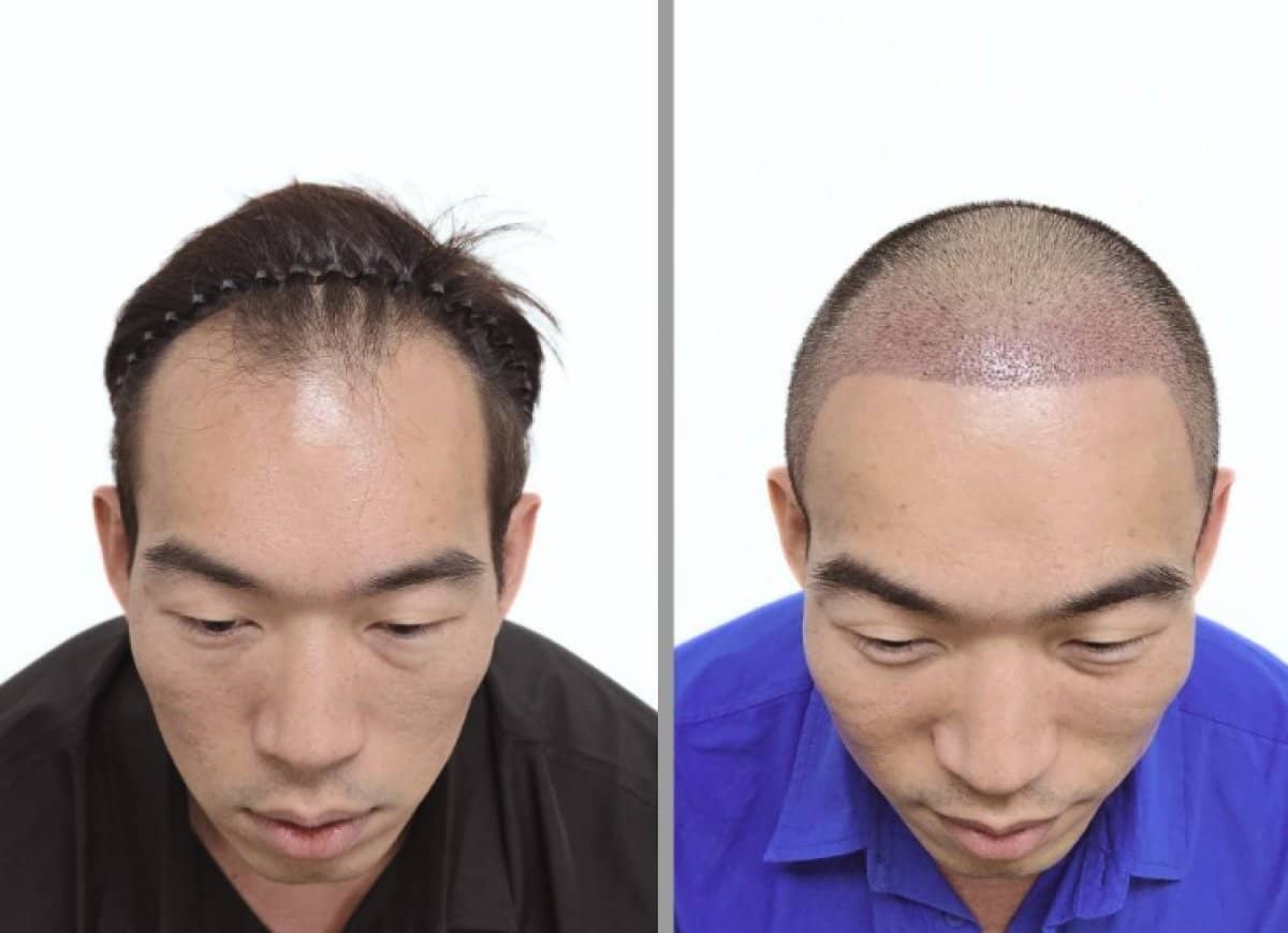 Case 18902 - hair transplant