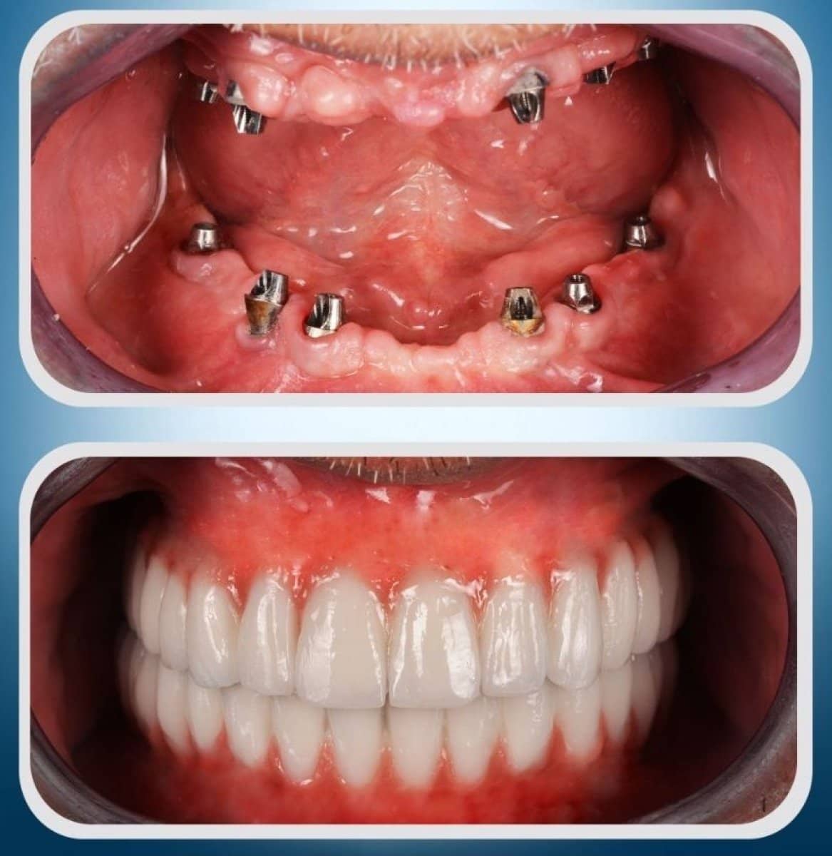 Case 18915 - All-on-6 dental implants