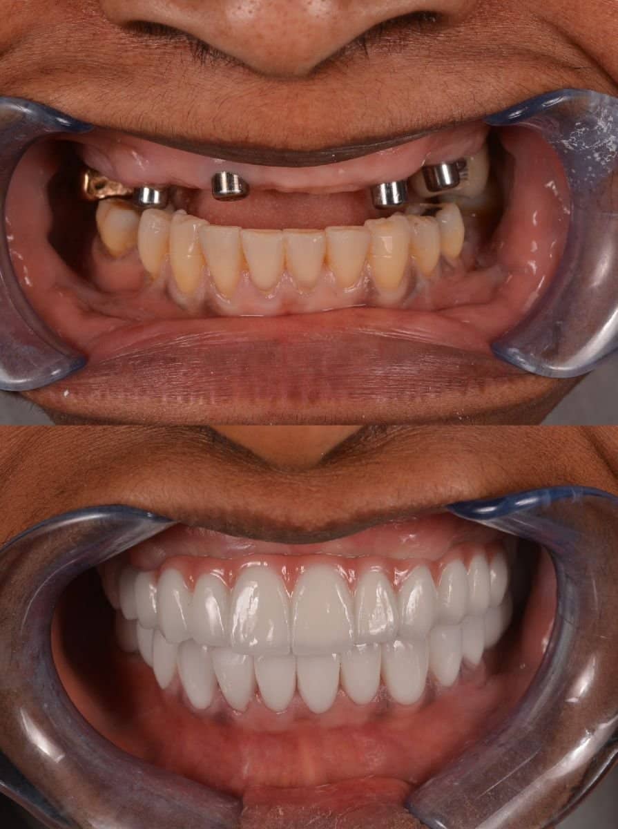 Case 18922 - All-on-6 dental implants
