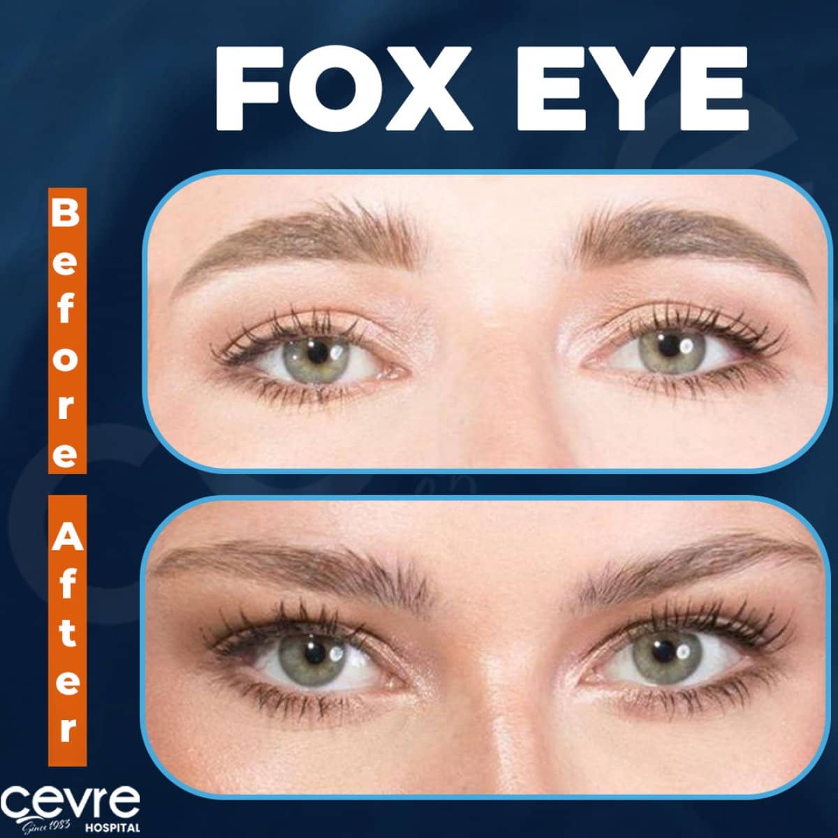 Case 18925 - Fox Eye Lift