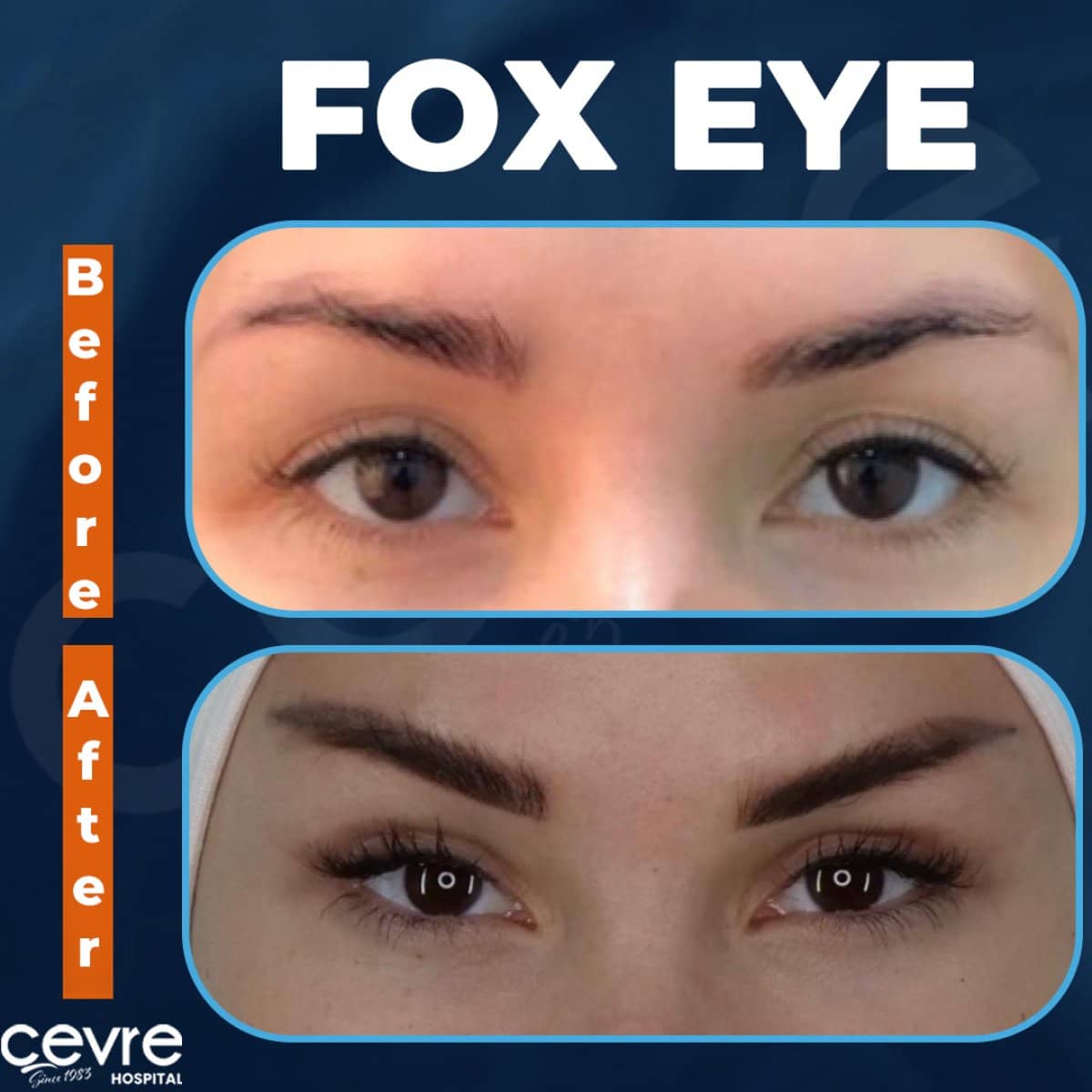 Case 18926 - Fox Eye Lift