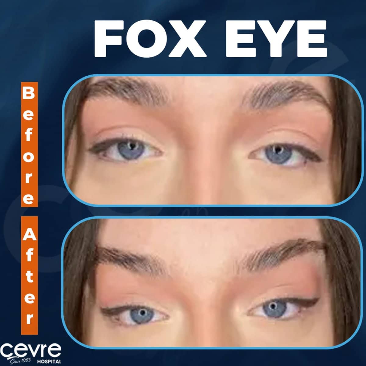 Case 18927 - Fox Eye Lift