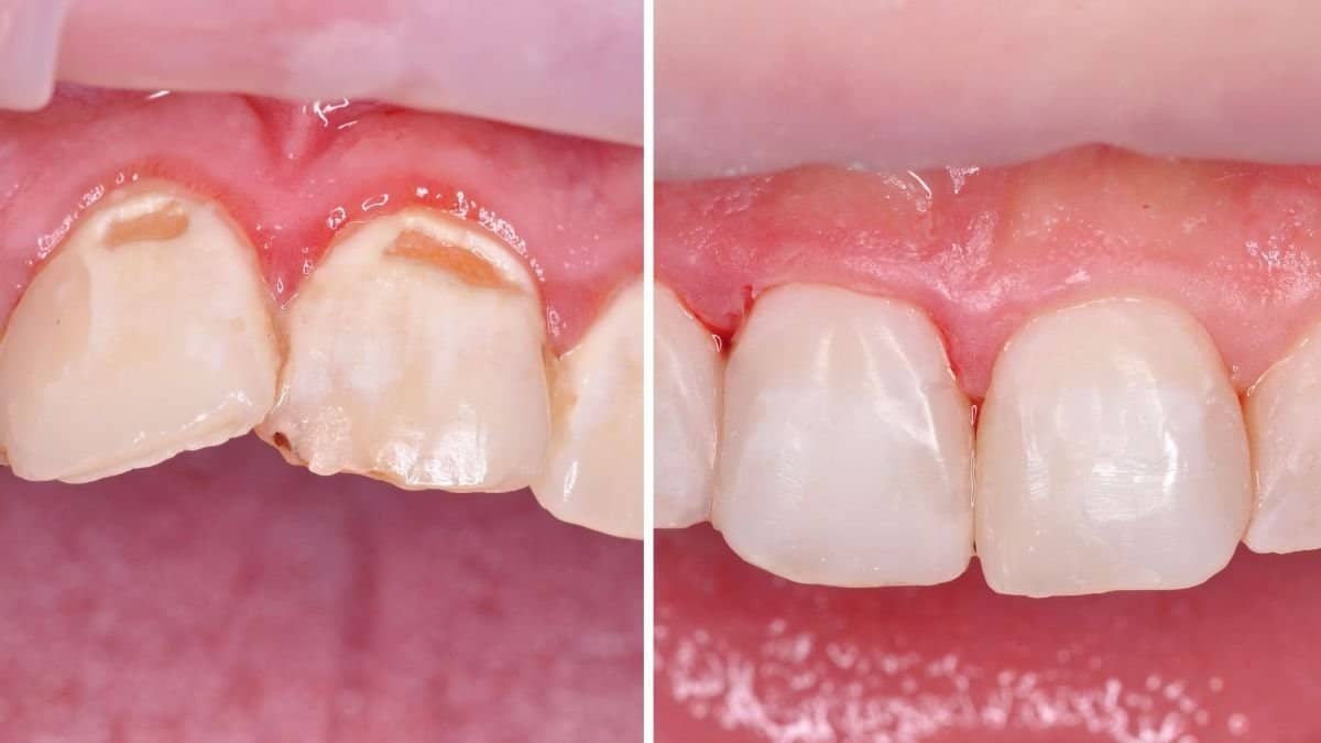 Case 18941 - crown lengthening