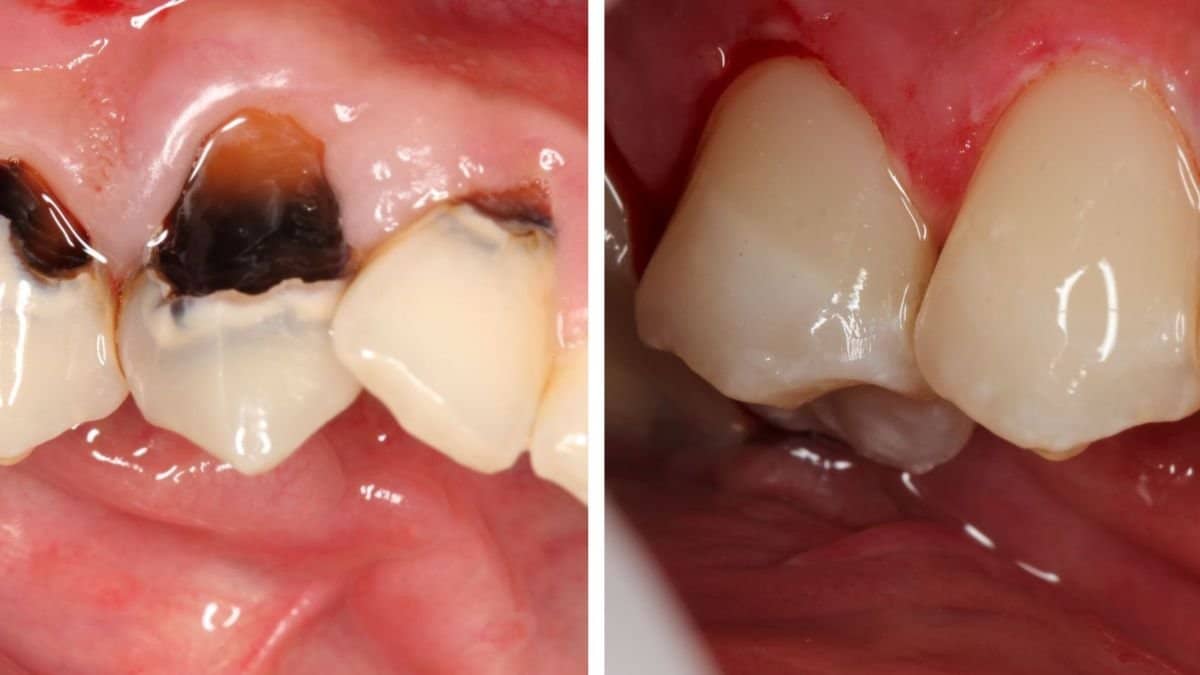 Case 18943 - crown lengthening