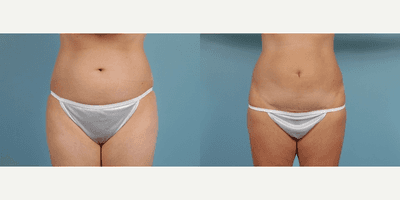 Case 1896 - Woman treated with Tummy Tuck