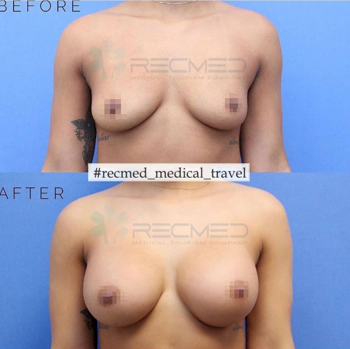 Case 18963 - breast lift with implants round