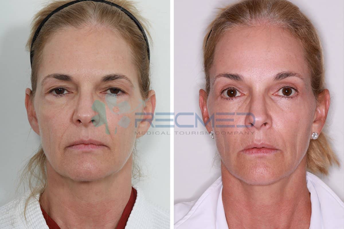 Case 18967 - blepharoplasty