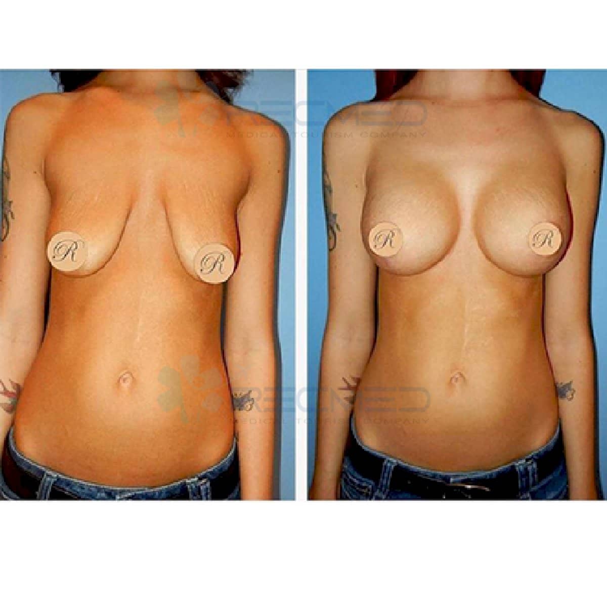 Case 18968 - breast implants with lift