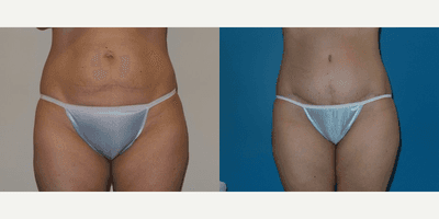 Case 1897 - Woman treated with Tummy Tuck