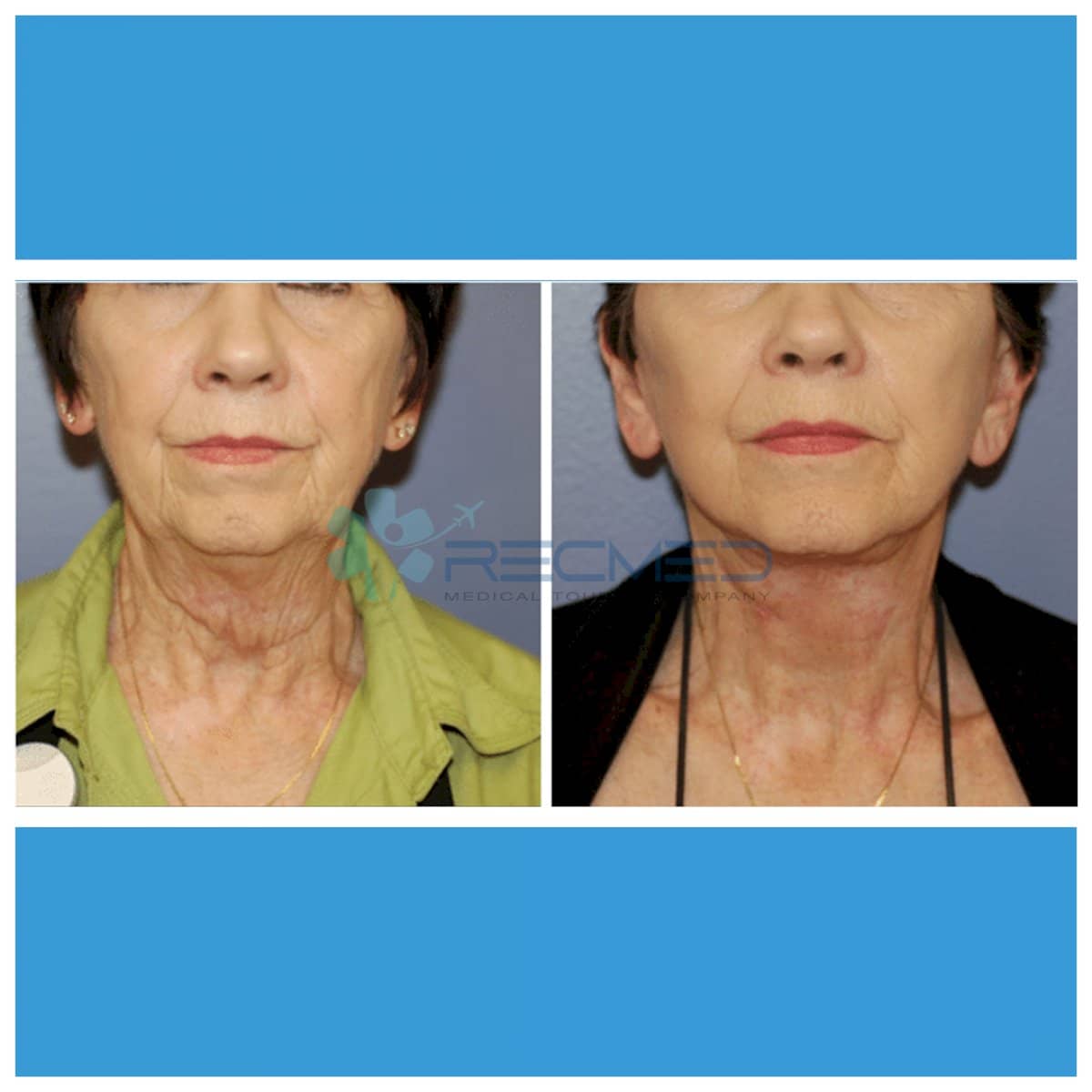 Case 18972 - neck lift