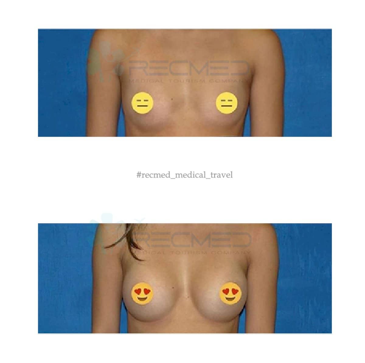 Case 18973 - breast augmentation