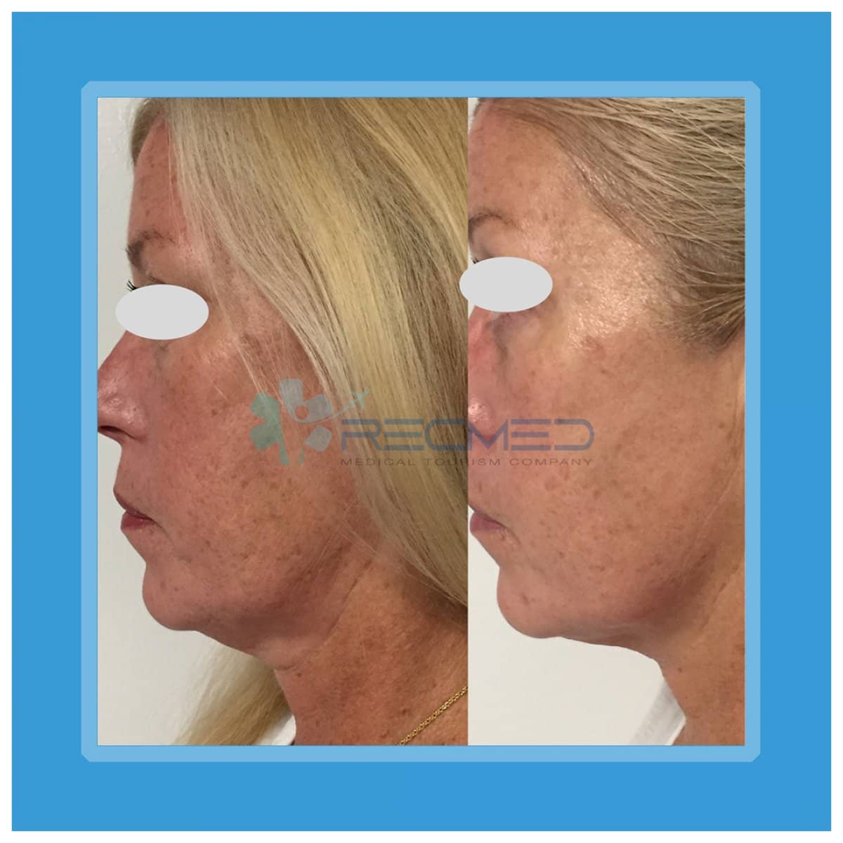 Case 18974 - neck lift