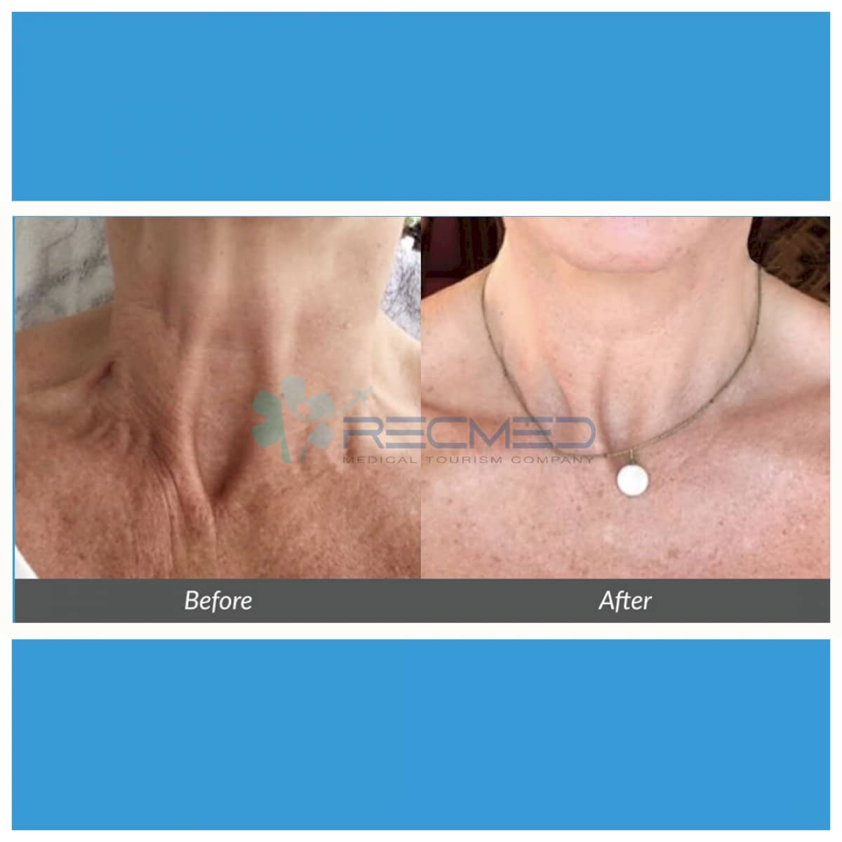 Case 18976 - neck lift