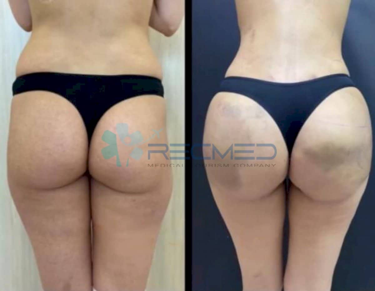 Case 18978 - Brazilian Butt Lift