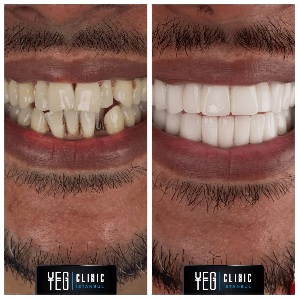 Case 18989 - dental implant