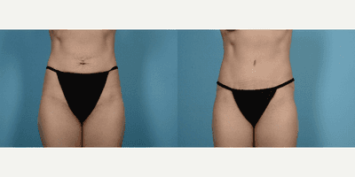 Case 1899 - Woman treated with Tummy Tuck