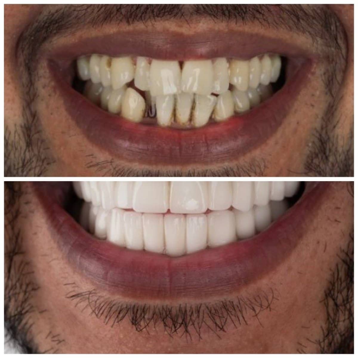Case 18990 - All-on-4 dental implants