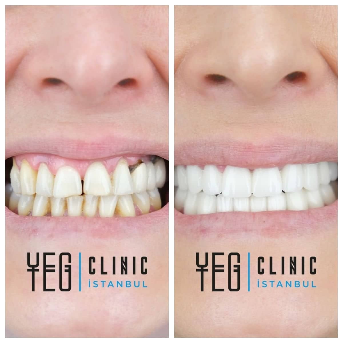 Case 18995 - All-on-6 dental implants