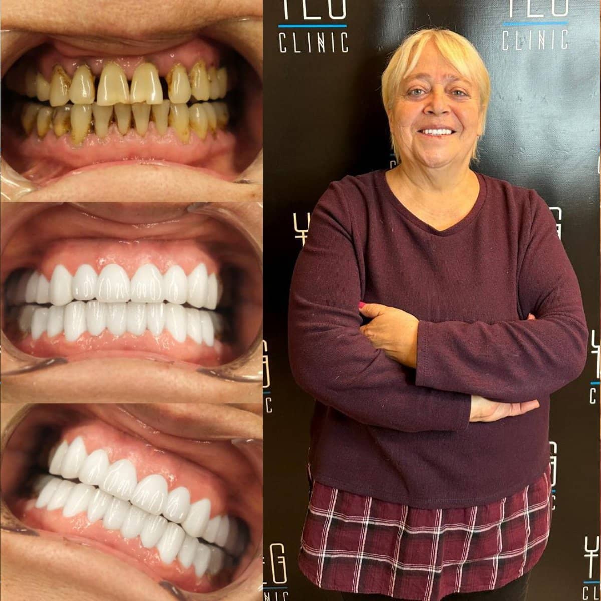 Case 18997 - dental implant with crown