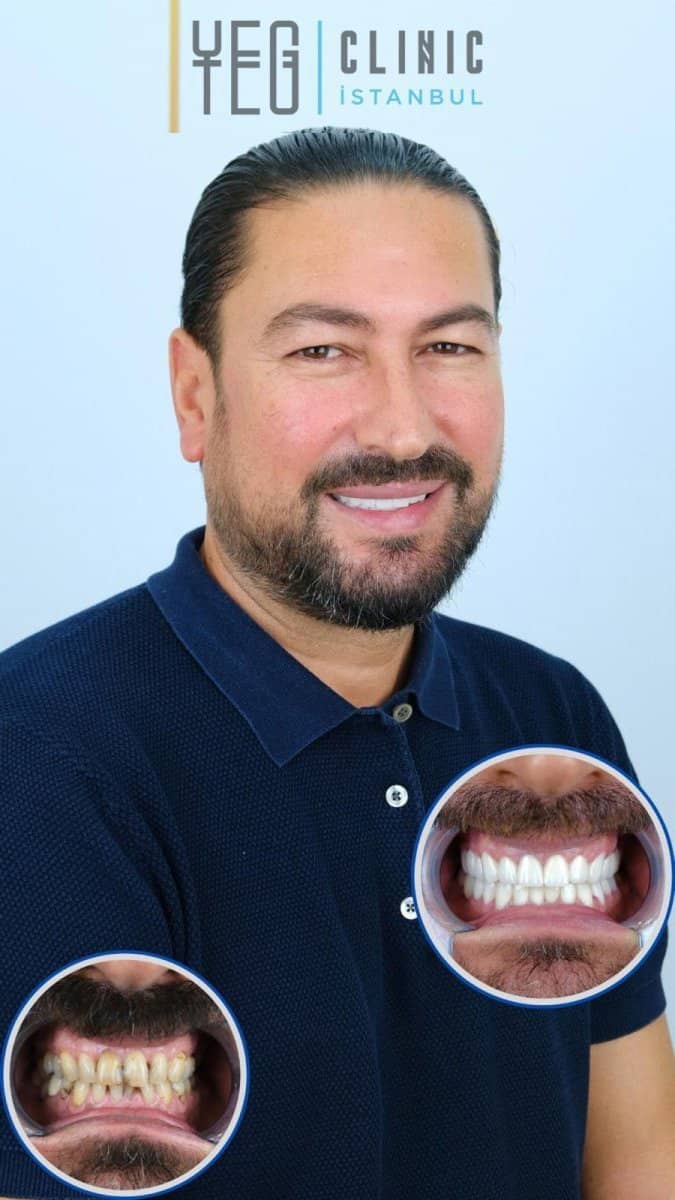 Case 18998 - dental crown replacement