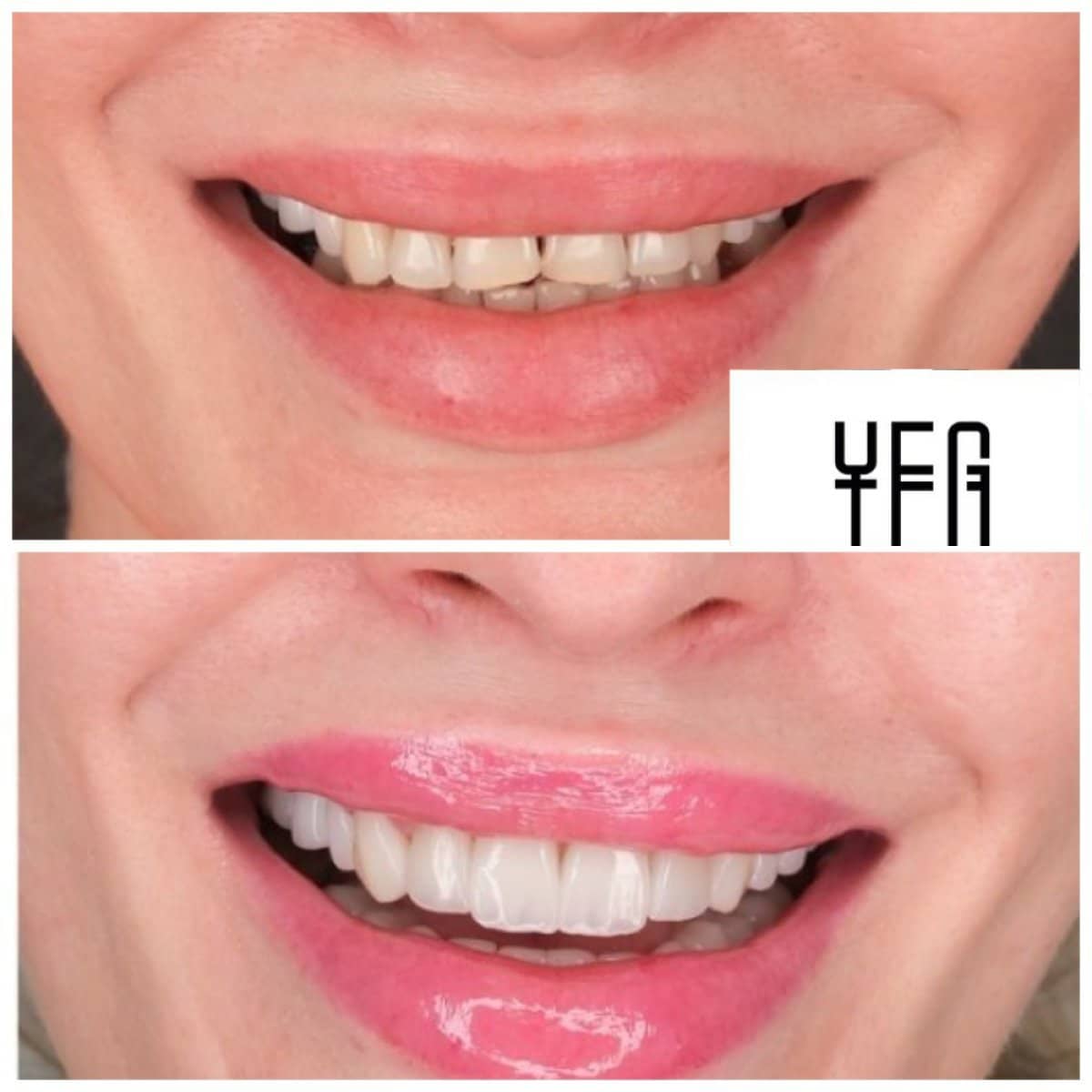 Case 19000 - denture