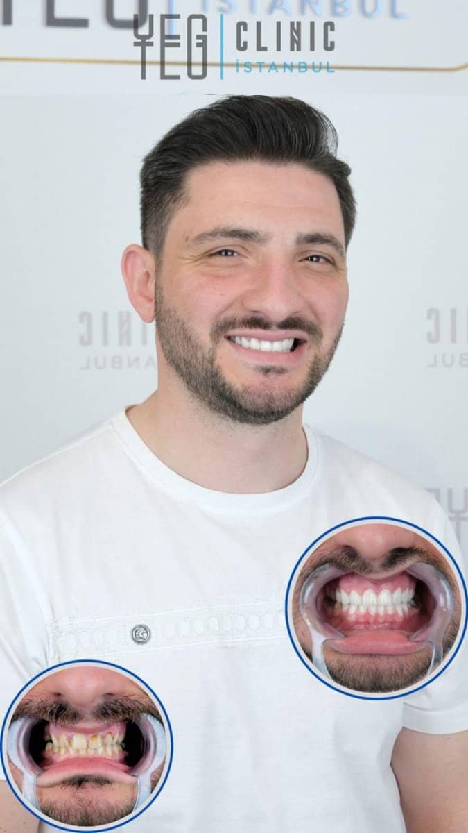 Case 19004 - results of full-arch implant-fixed zirconia dentures