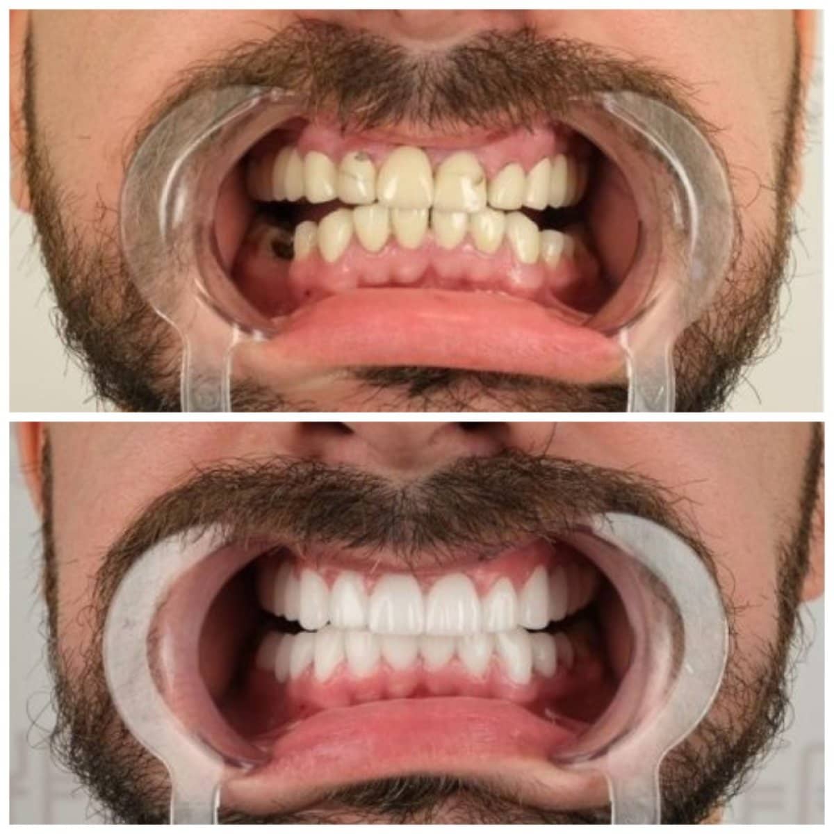 Case 19005 - denture procedure