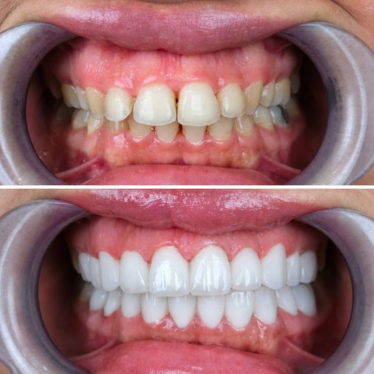 Case 19006 - porcelain crown installation