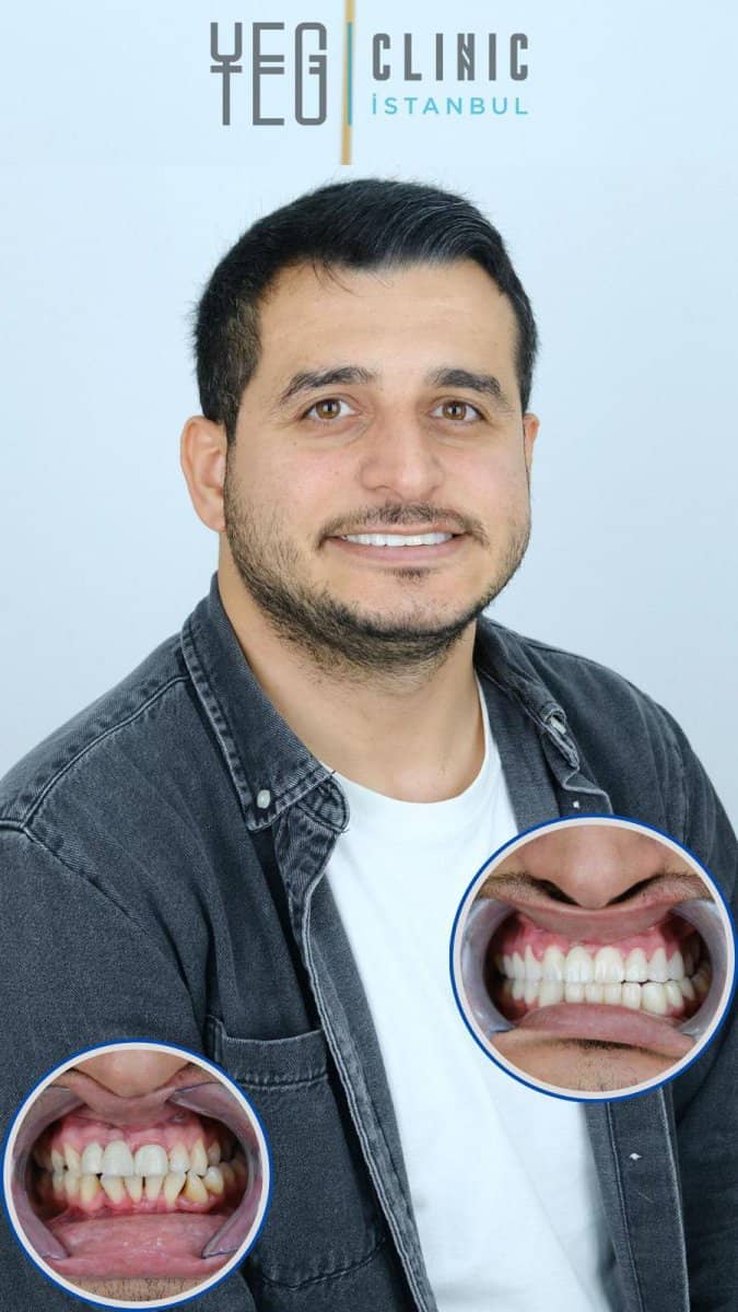 Case 19007 - implant bridge