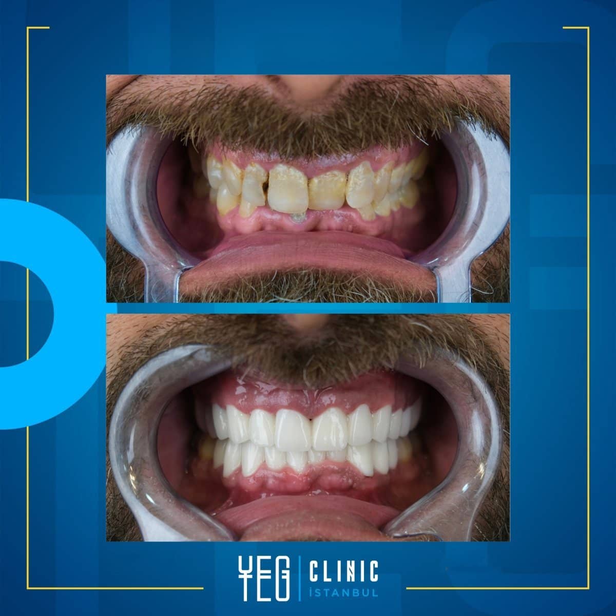 Case 19008 - denture