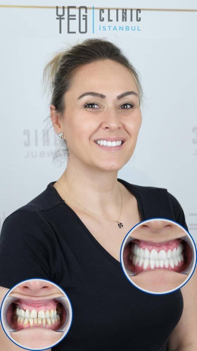 Case 19010 - tooth whitening