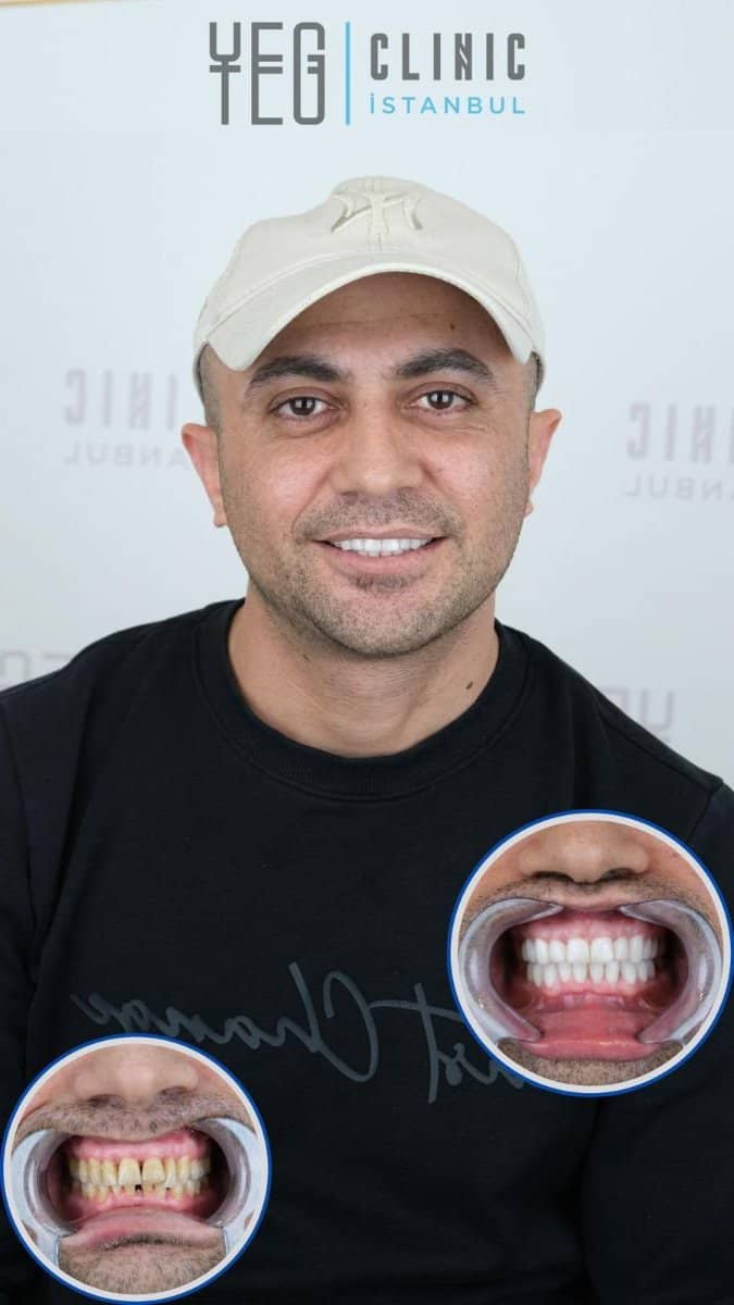 Case 19018 - tooth whitening