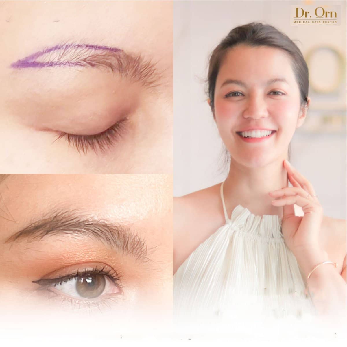 Case 19030 - eyebrow transplantation