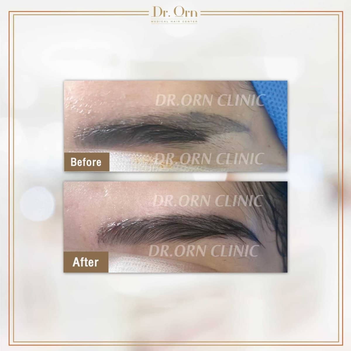 Case 19031 - eyebrow transplantation