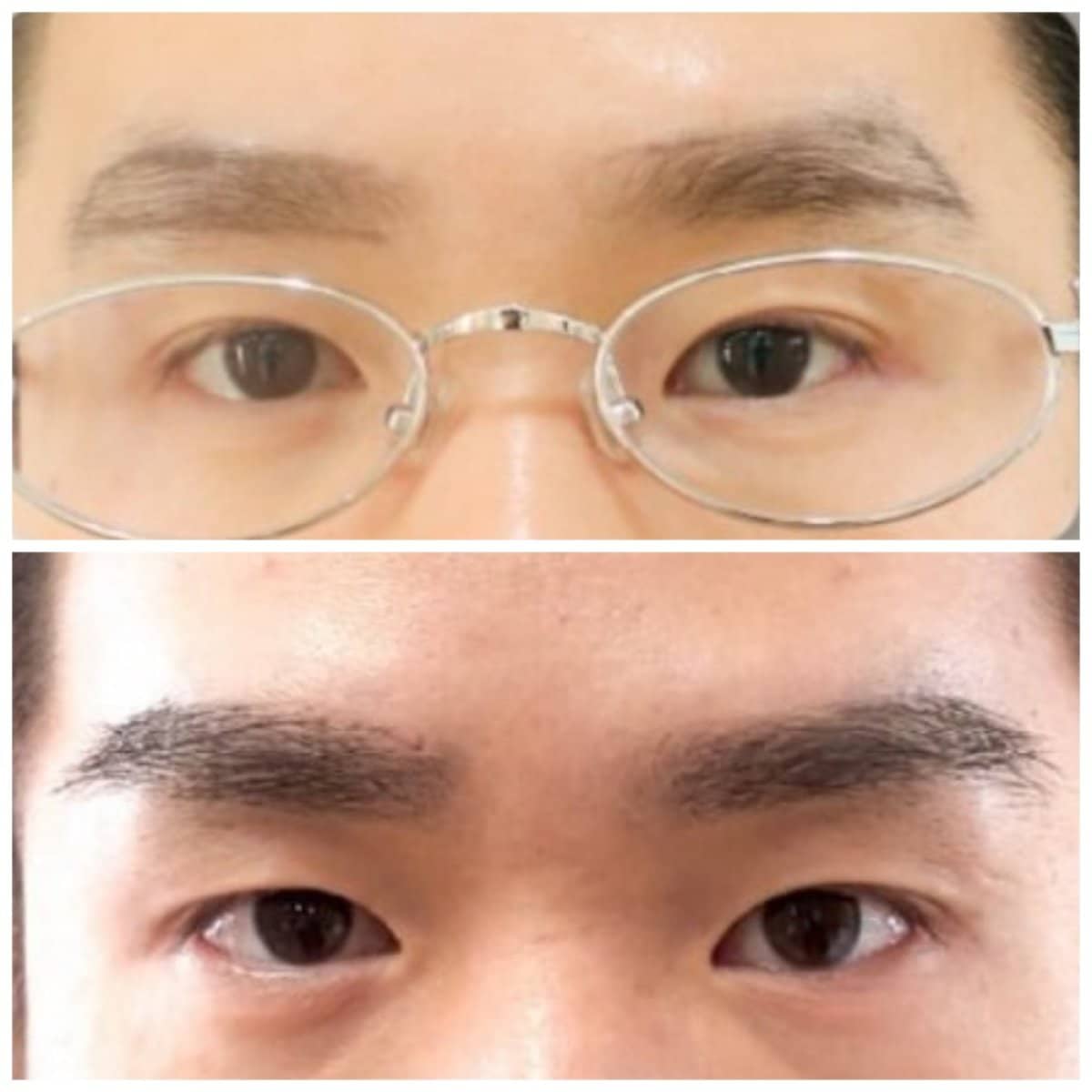 Case 19042 - eyebrow transplant