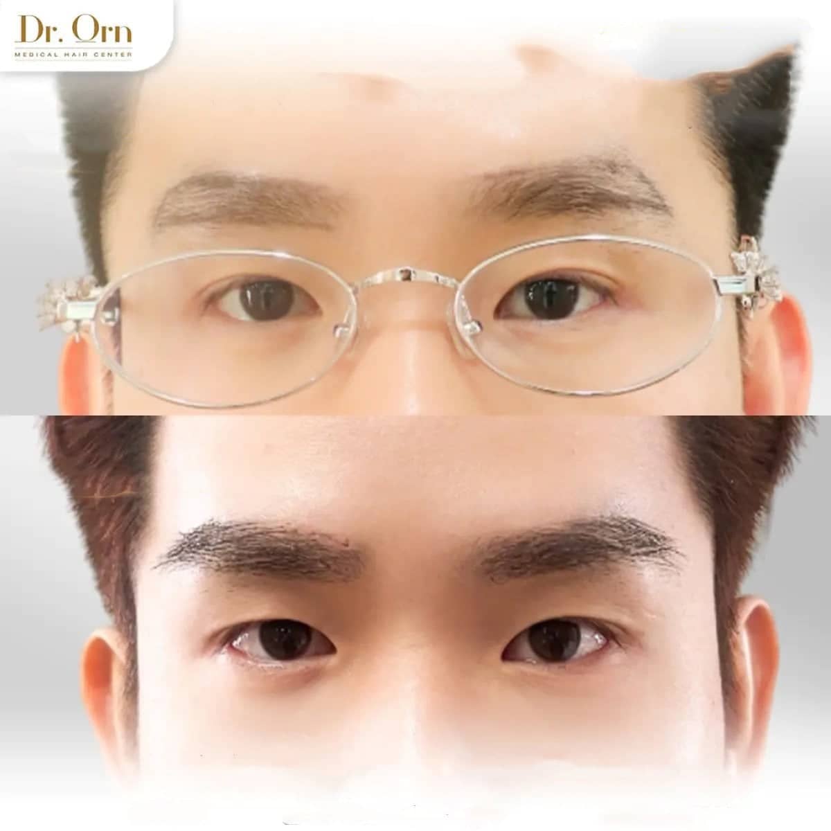 Case 19044 - eyebrow transplant