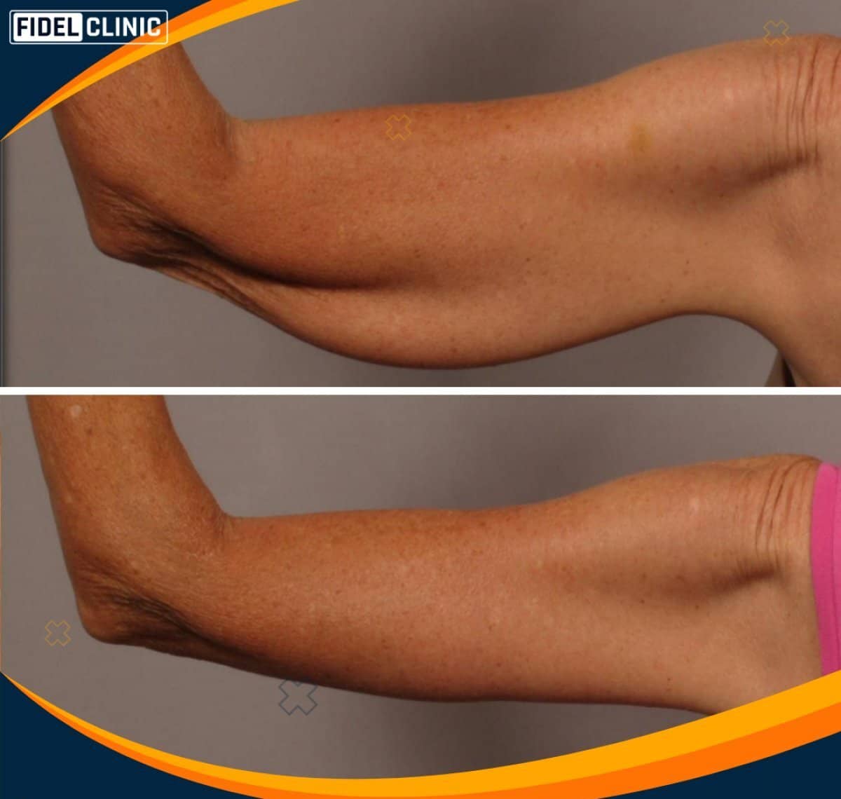 Case 19097 - arm lift (brachioplasty)